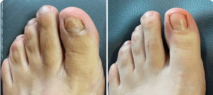 What is Oriveille Nail Fungus Pen – Oriveille