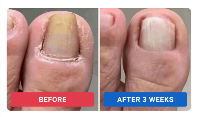 Oriveille Nail Fungus Pen review by Dan R. – Oriveille