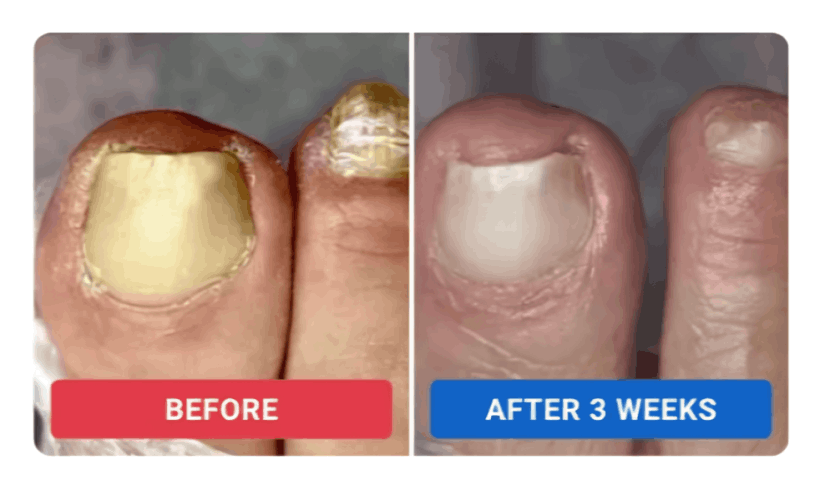 Oriveille Nail Fungus Pen review by Elena S. – Oriveille
