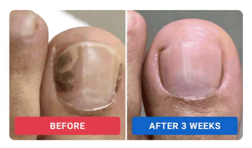 Oriveille Nail Fungus Pen review by Rachel M. – Oriveille