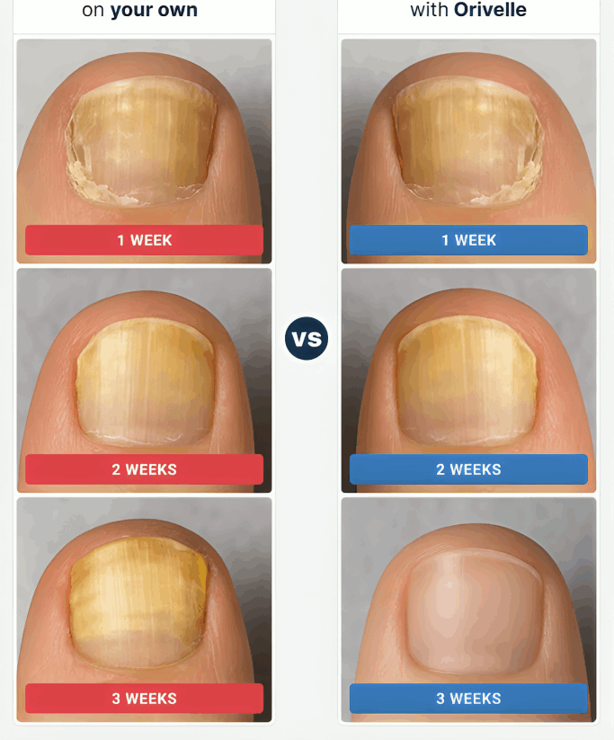 Oriveille Nail Fungus Pen before and after – Oriveille